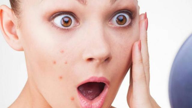 Serba-serbi Jerawat dan Perawatan Terbaik Theraskin Paket Acne